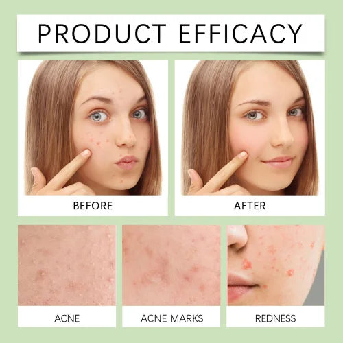 OUHOE Anti-Blemish Pore Patch – Gentle Acne Care and Skin Recovery