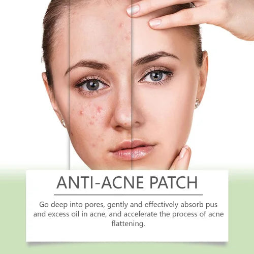 OUHOE Anti-Blemish Pore Patch – Gentle Acne Care and Skin Recovery
